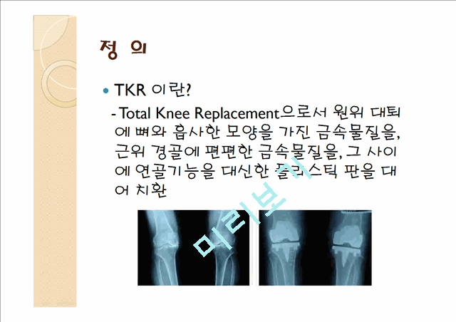 [의학,약학][의학] 인공 슬관절 전치환술 [Total knee replacement]   (3 )